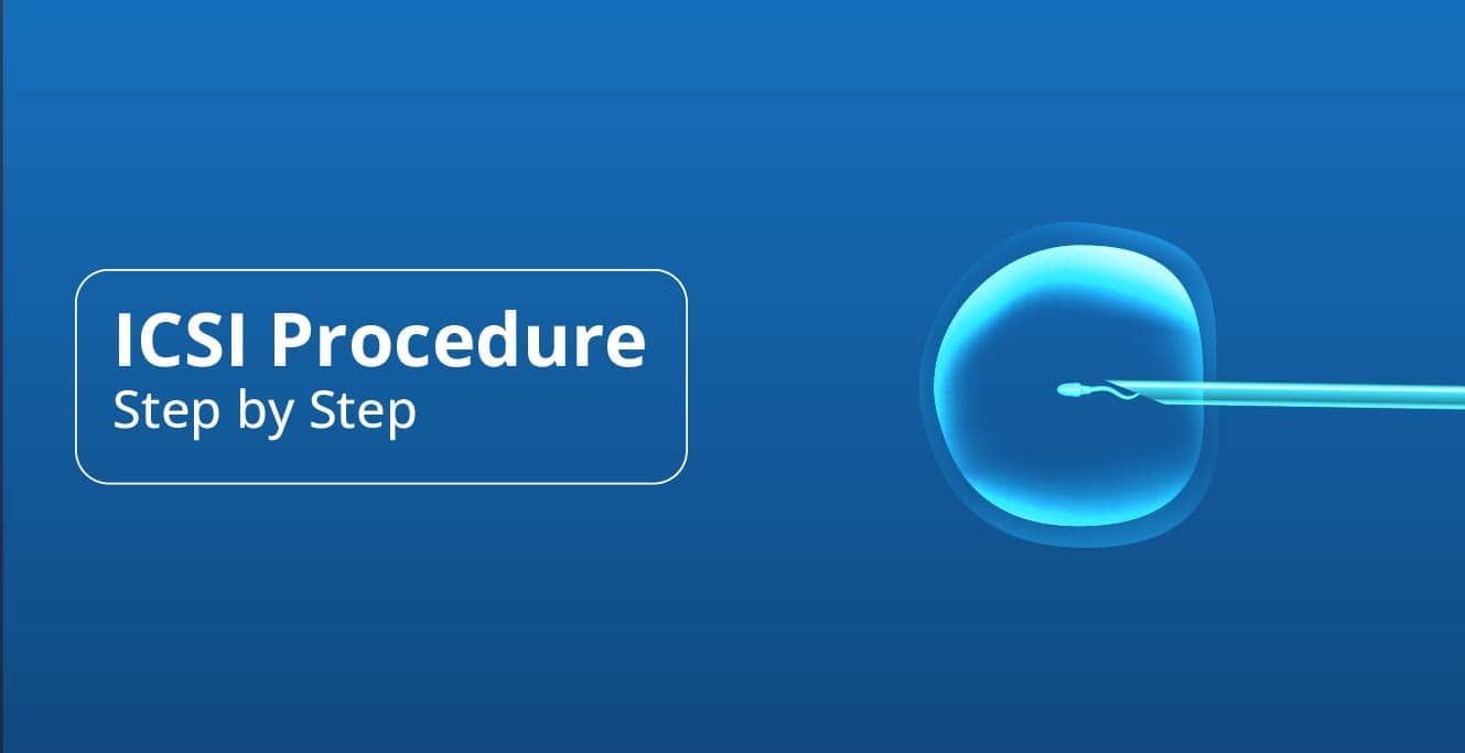 Step-by-Step Guide to the ICSI Procedure