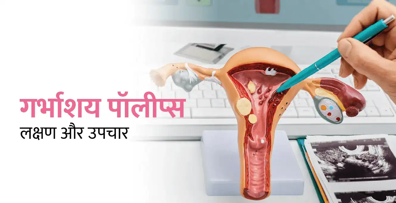 एंडोमेट्रियल पॉलीप्स (गर्भाशय पॉलीप्स): लक्षण और उपचार