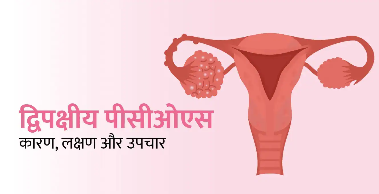 बायलैटरल पीसीओएस: कारण, लक्षण और उपचार