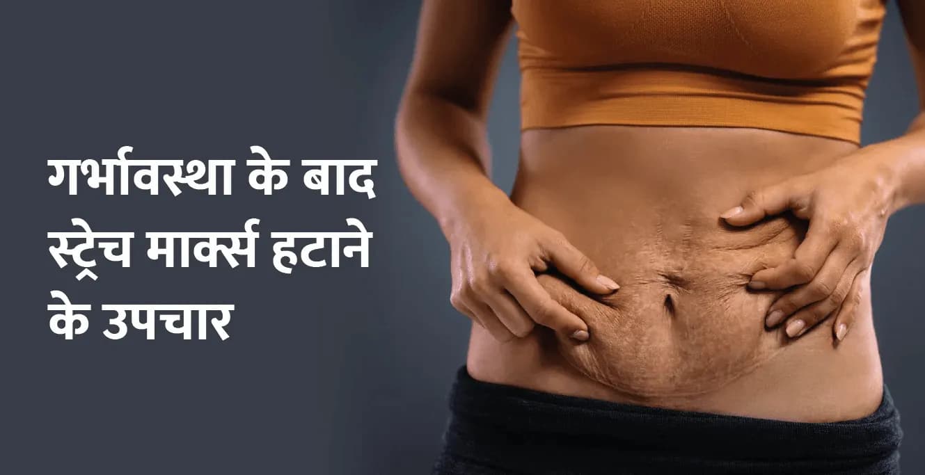 गर्भावस्था के बाद स्ट्रेच मार्क्स हटाने के उपचार